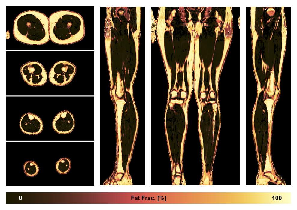 The fat fraction of the lower extremity obtained from the dixon reconstruction for muscle water fat quantification.